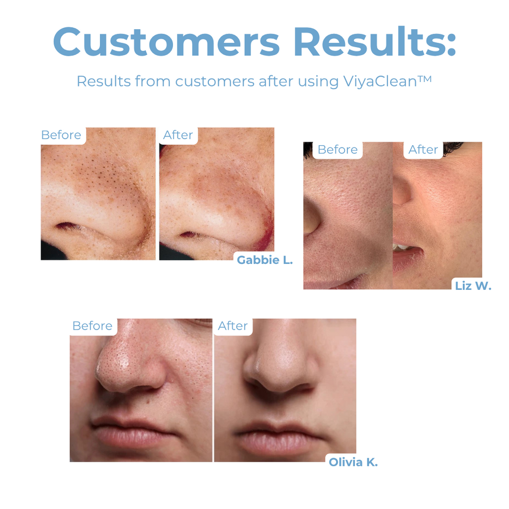 ViyaClean™ – Sichtbar reinigende Porenpflege für eine frische Haut [5 + 5 Gratis]