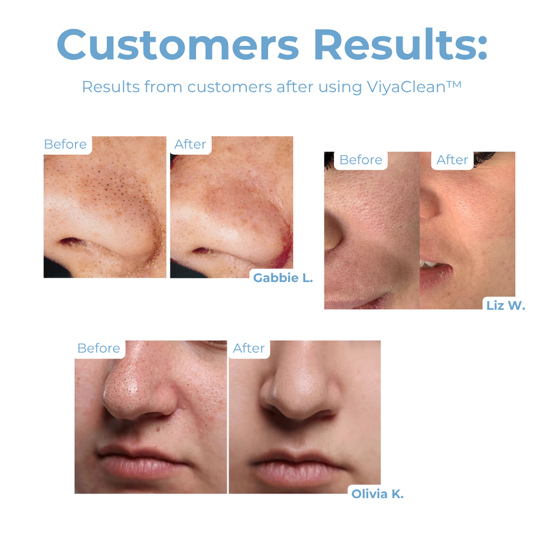 ViyaClean™ – Sichtbar reinigende Porenpflege für eine frische Haut [5 + 5 Gratis]