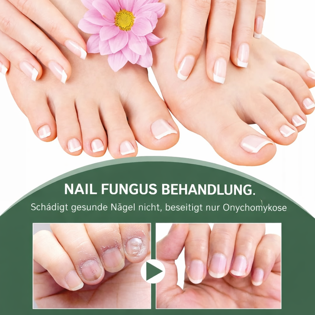 1+1 GRATIS | Nagelpilz-Reparaturserum | Heilt, Restauriert & Schützt Beschädigte Nägel