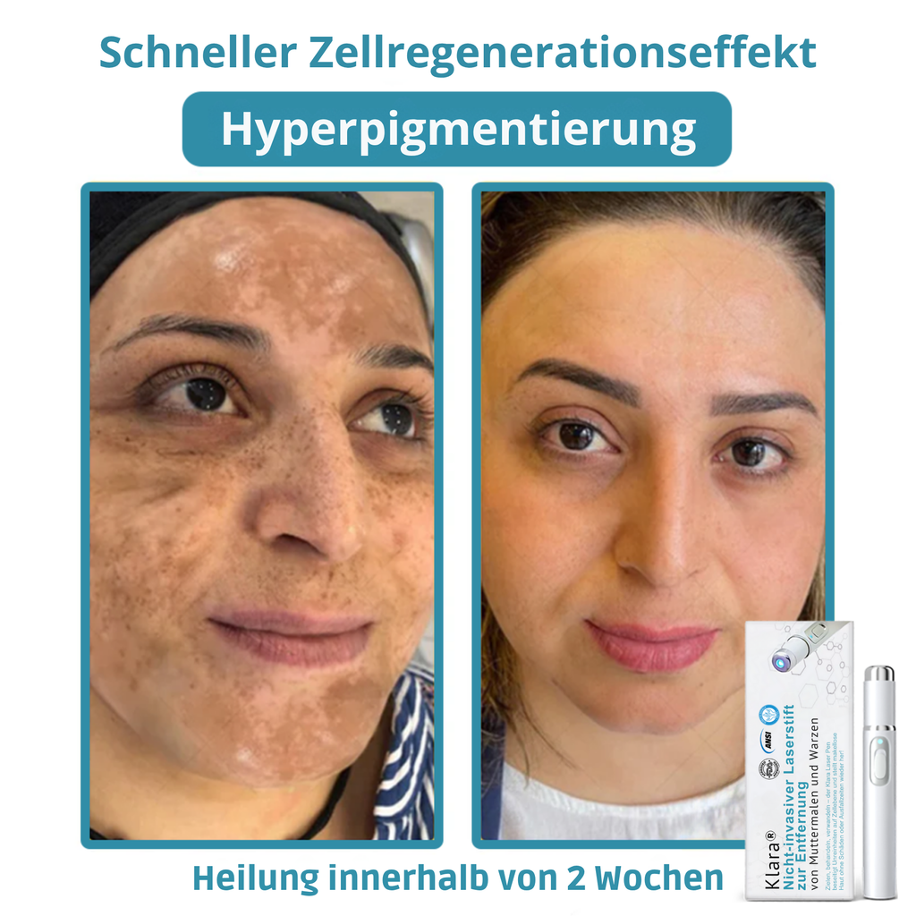 Klara™ – Erlebe jederzeit ebenmäßige, strahlende Haut und neues Selbstvertrauen [50% Rabatt]