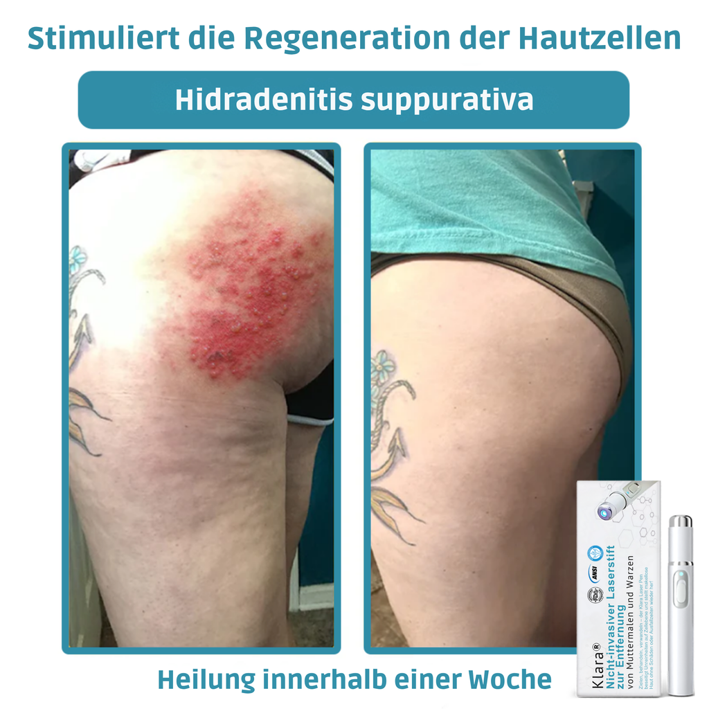 Klara™ – Erlebe jederzeit ebenmäßige, strahlende Haut und neues Selbstvertrauen [50% Rabatt]