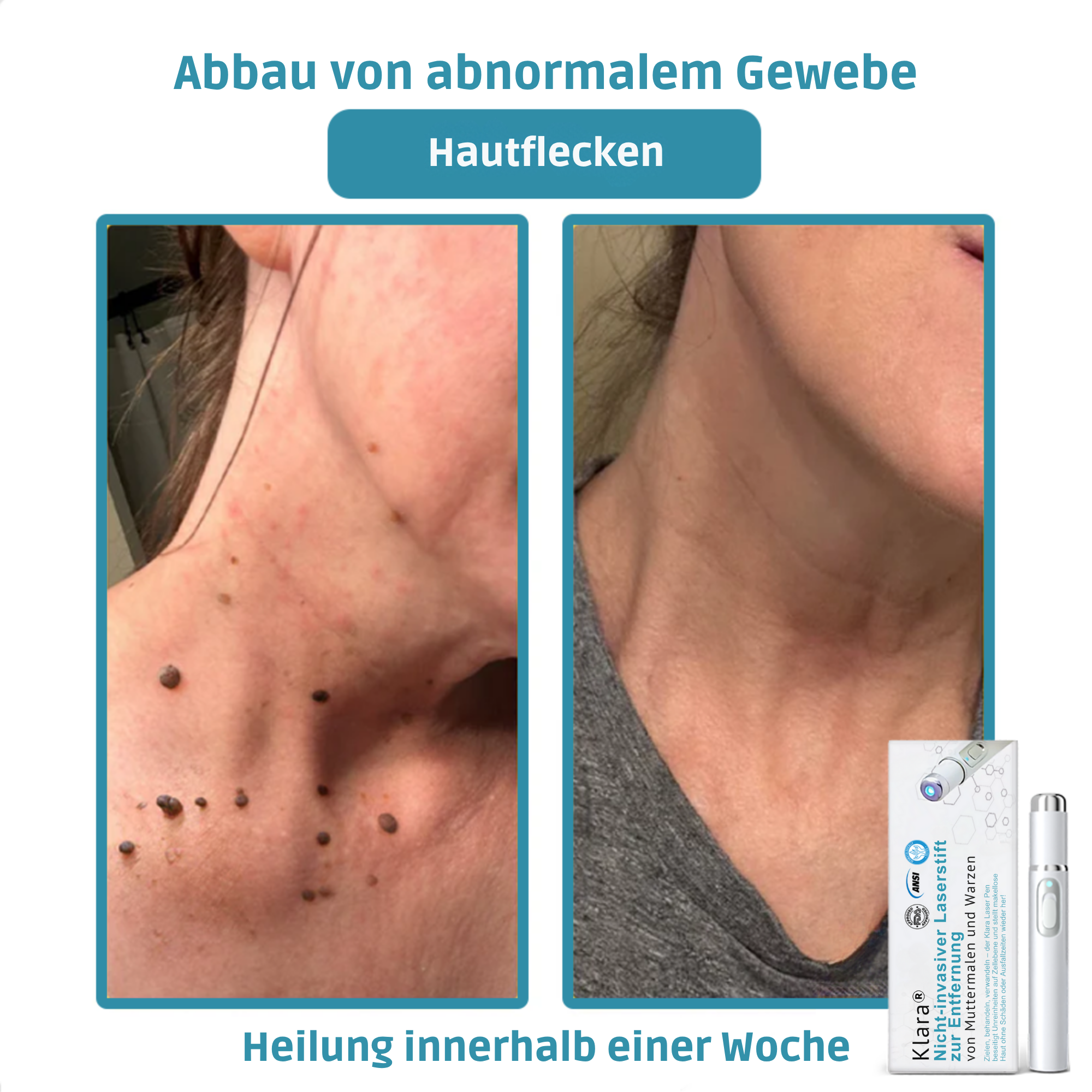 DermaLuxe™ ClearPen – Präzisions-Laserpen für ein ebenmäßiges Hautbild [50% RABATT]