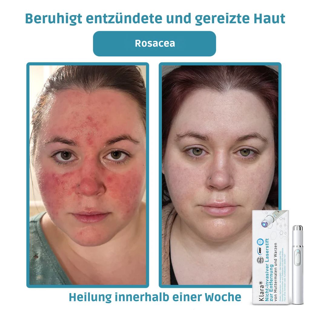 DermaLuxe™ ClearPen – Präzisions-Laserpen für ein ebenmäßiges Hautbild [50% RABATT]