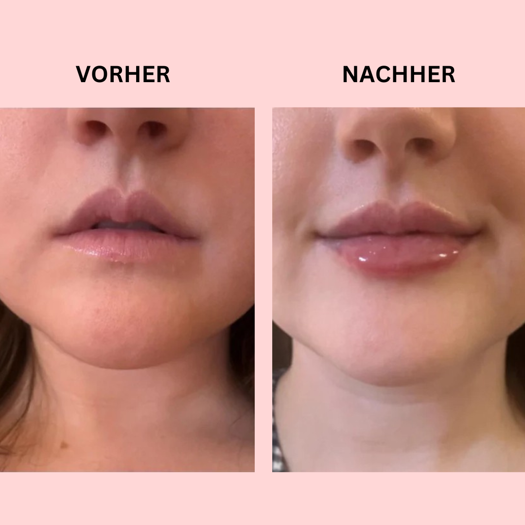 LipBoost Set – Sichtbar vollere Lippen in nur wenigen Wochen – ganz natürlich & ohne Spritzen.