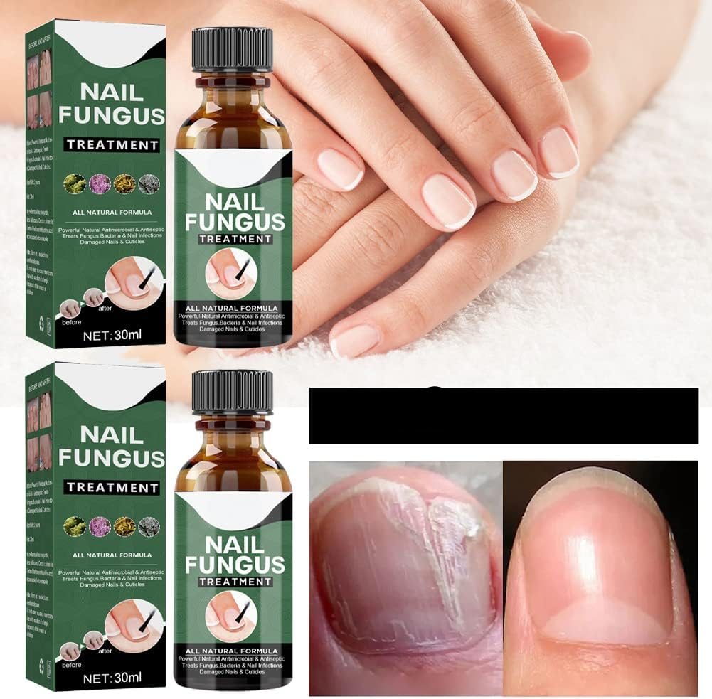 1+1 GRATIS | Nagelpilz-Reparaturserum | Heilt, Restauriert & Schützt Beschädigte Nägel