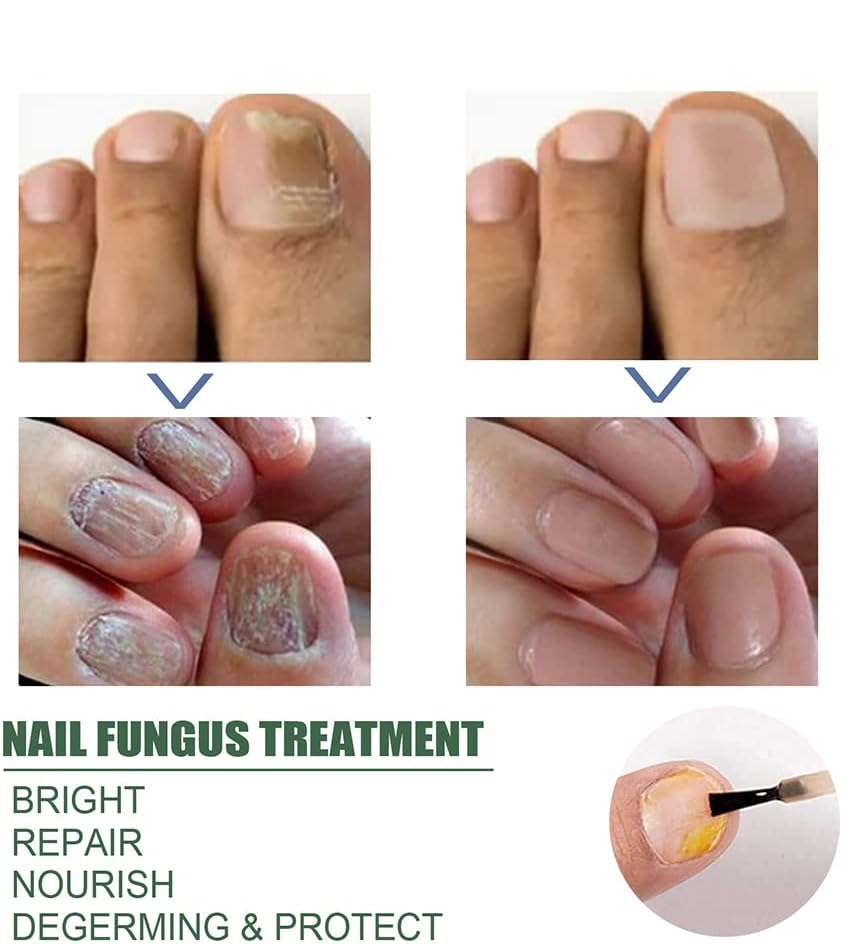 1+1 GRATIS | Nagelpilz-Reparaturserum | Heilt, Restauriert & Schützt Beschädigte Nägel