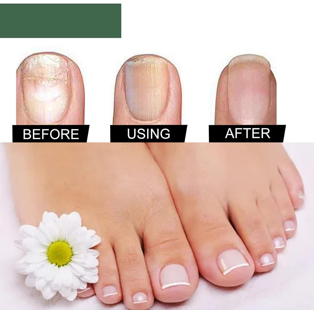 1+1 GRATIS | Nagelpilz-Reparaturserum | Heilt, Restauriert & Schützt Beschädigte Nägel