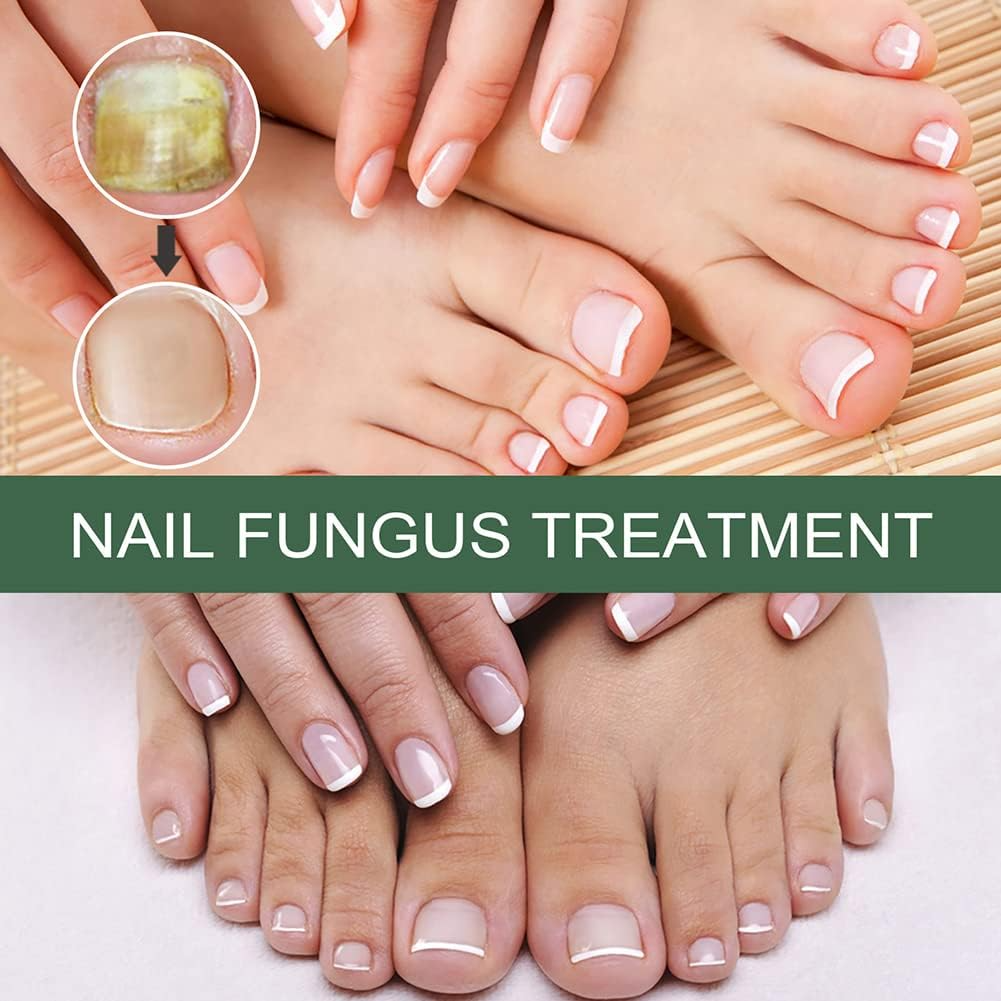 1+1 GRATIS | Nagelpilz-Reparaturserum | Heilt, Restauriert & Schützt Beschädigte Nägel