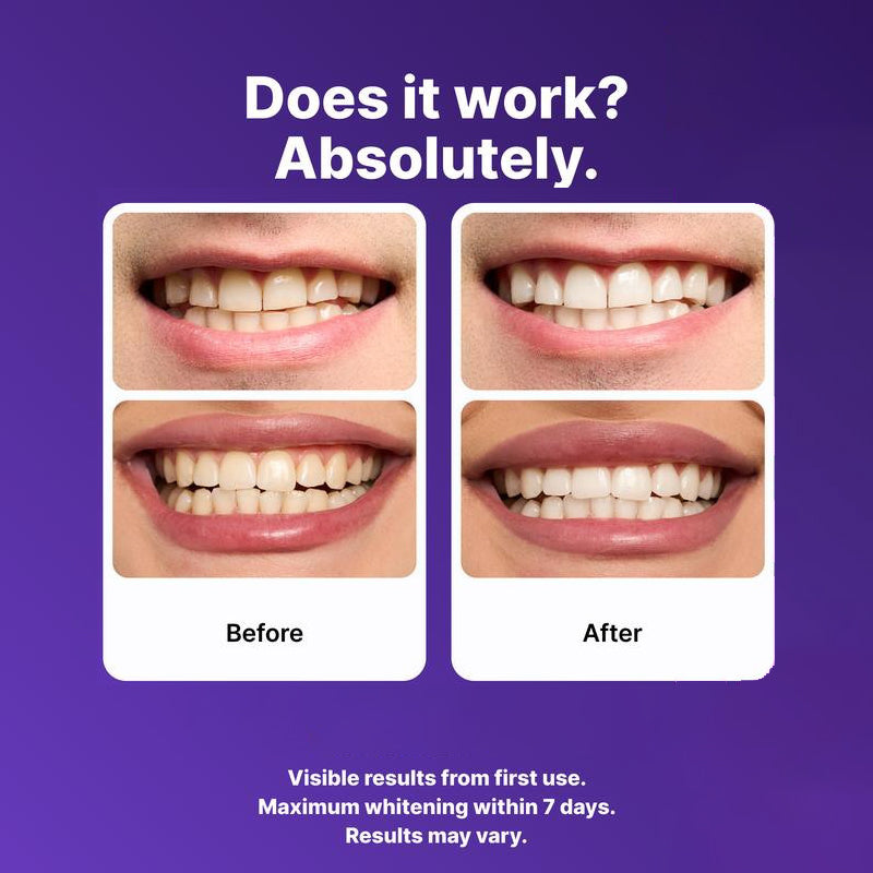 SmileVio™ GlowStrips – Sanfte violette Whitening-Streifen für natürlich weiße Zähne